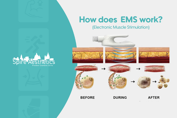 EMS treatment for post pregnancy weight loss treatment Dunmow