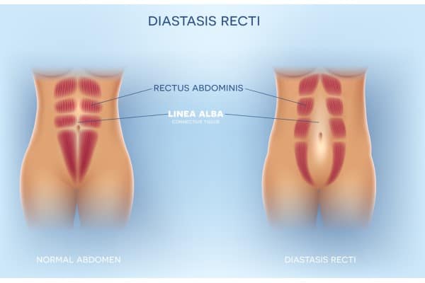 What Non-Surgical Options Are Available for Diastasis Recti Dunmow?