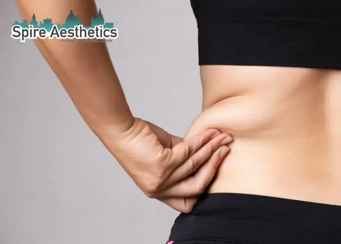 Image of woman pinching fat on their hips Dunmow. Fat Freezing treatment