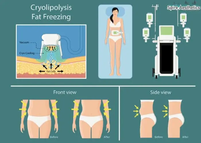 Fat freezing treatment Dunmow benefits for competitions to remove stubborn fat deposits.
