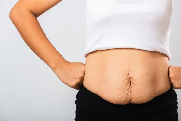 Image of a woman's stomach after weight loss with sagging skin following a gastric band Dunmow