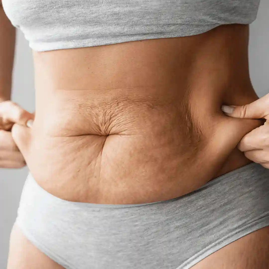 Is It Normal to Have Loose Skin After Pregnancy Dunmow?