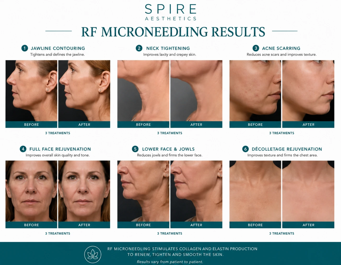 RF Microneedling Skin tightening Dunmow results