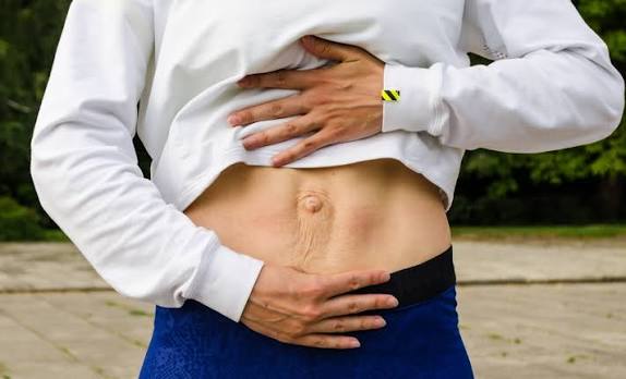 When Could Diastasis Recti Be the Missing Piece of the Puzzle Dunmow?