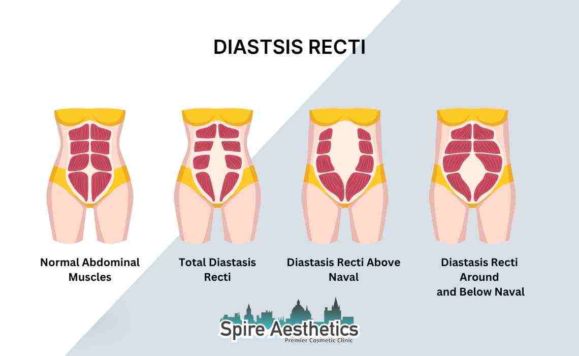 Is Non-Surgical Diastasis Recti Treatment Right for You? Common Concerns Answered Dunmow